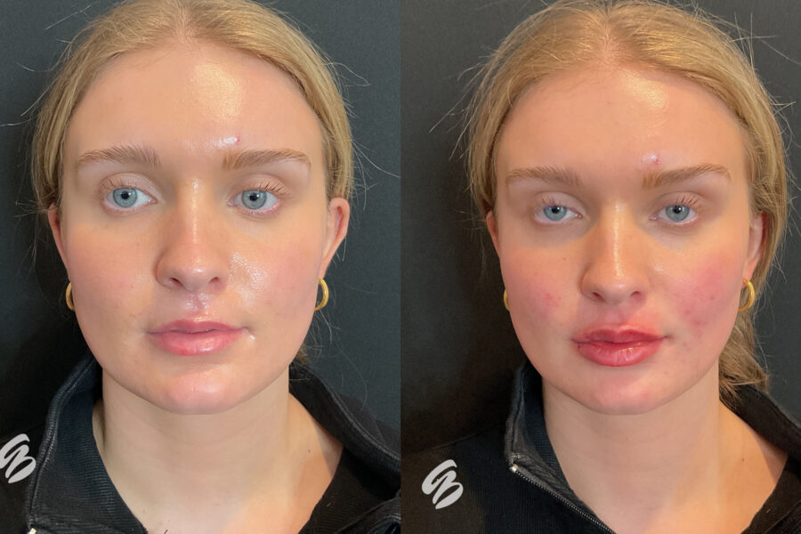 Before and after photo of patient who received lip filler in Cincinnati from Amy Brenner, MD & Associates. The after photo shows lips that have more volume, but still look natural.
